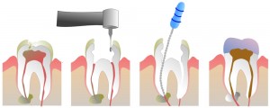 Teeth Root Canal procedure What-is-Root-Canal-Therapy-page Dr. Joshua Yadegar 