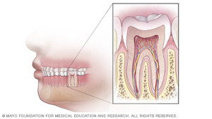 Root Canal Therapy