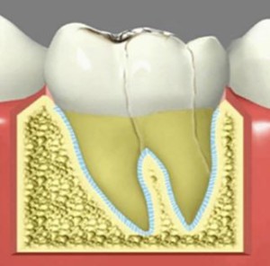 fractured tooth