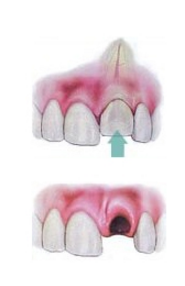 teeth avulsion